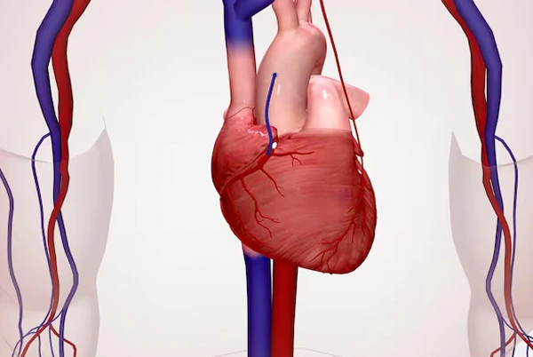 Coronary Angiography