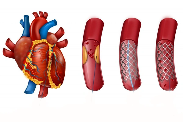 Primary Angioplasty for Heart Attack