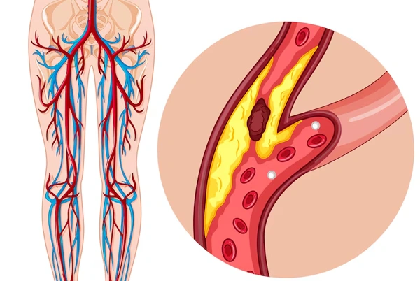 Peripheral Vascular Interventions